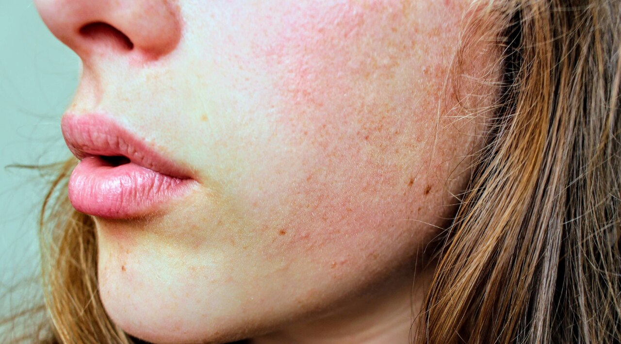 3. Anti Inflammatory and Soothes: