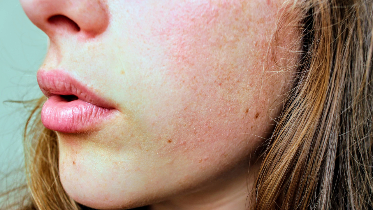 3. Anti Inflammatory and Soothes: