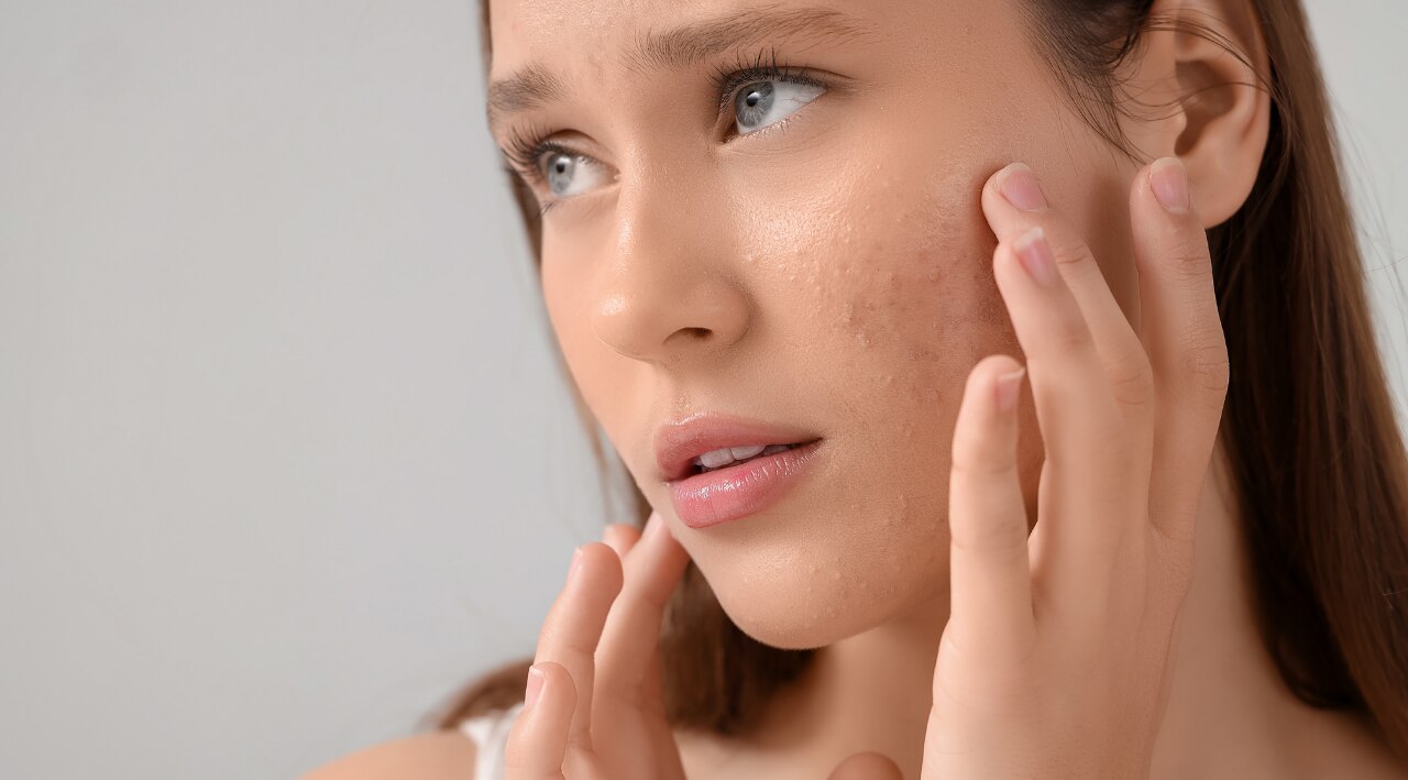 11. Acne and Oil Control: