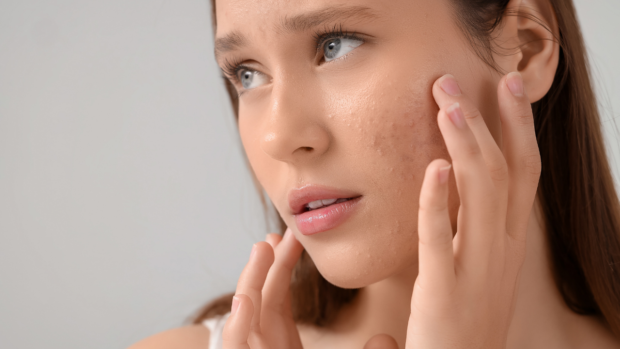 11. Acne and Oil Control: