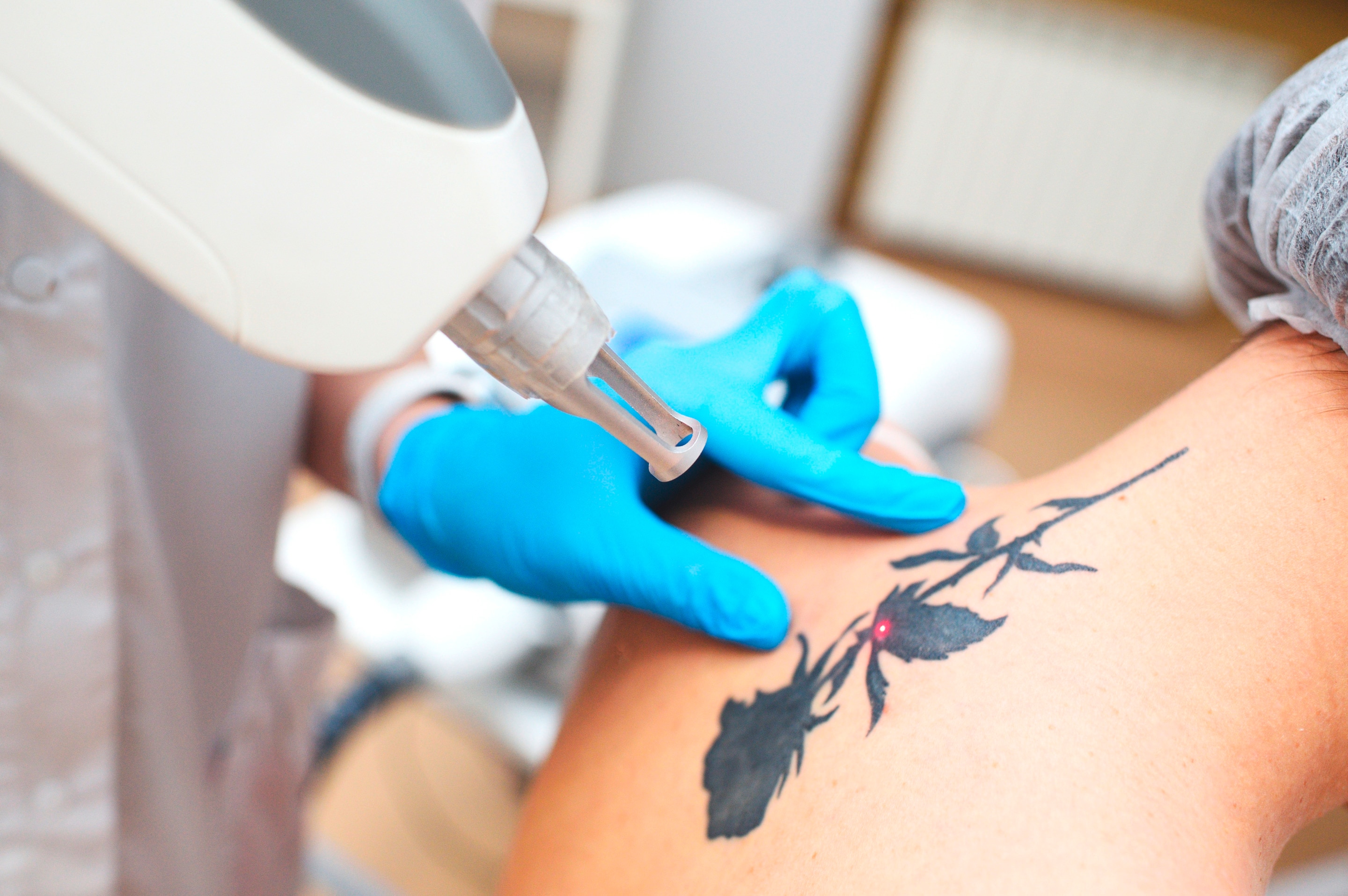 A tattoo being laser removed.
