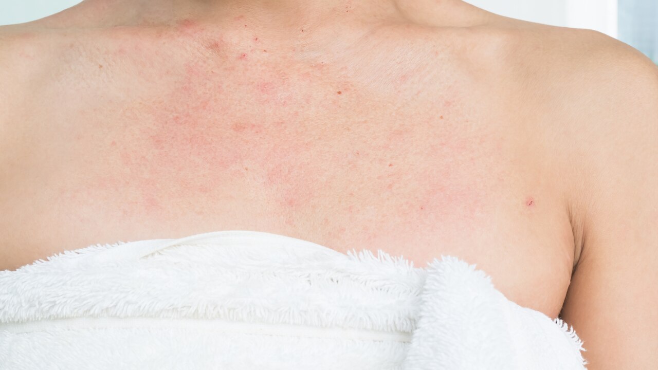 2. Soothing Eczema and Psoriasis: