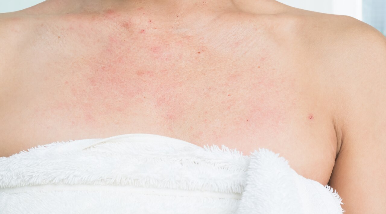 2. Soothing Eczema and Psoriasis: