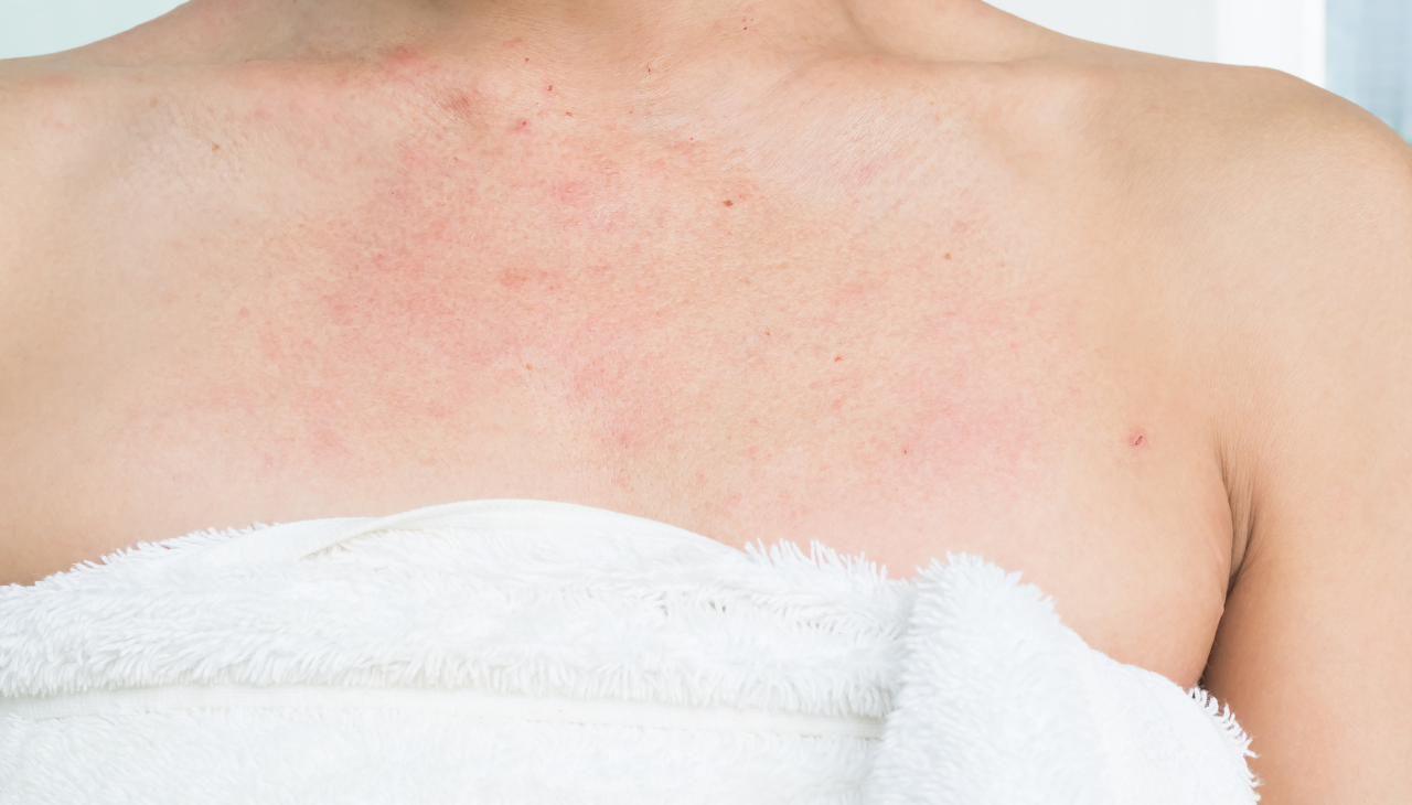 2. Soothing Eczema and Psoriasis: