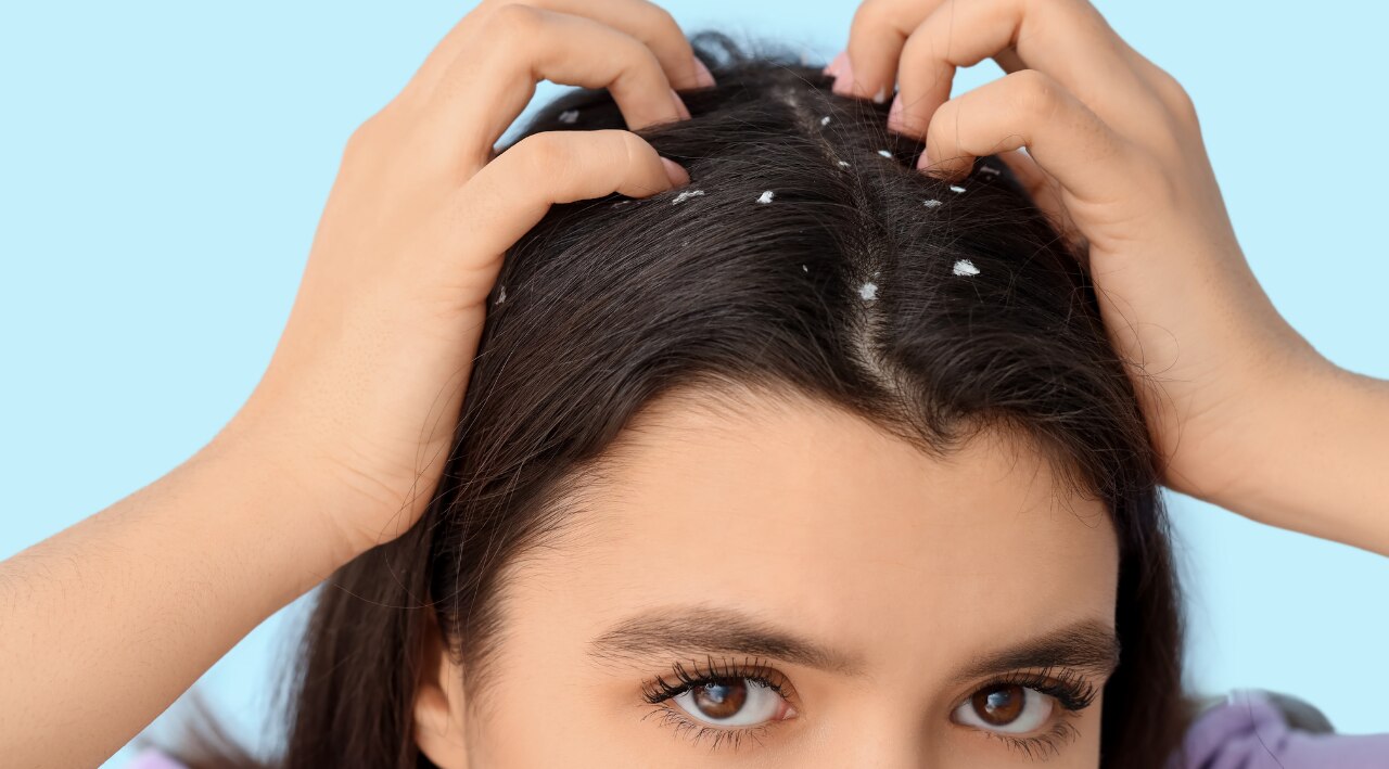 What Causes Dandruff?