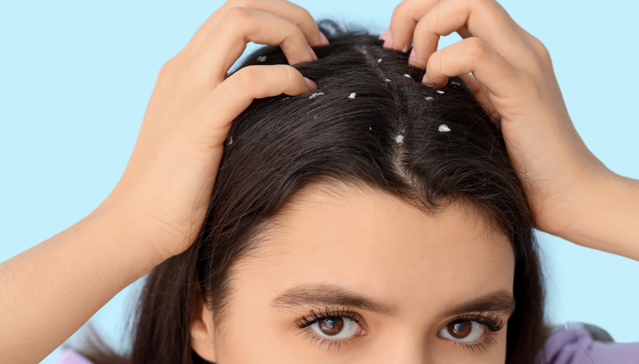 What Causes Dandruff?