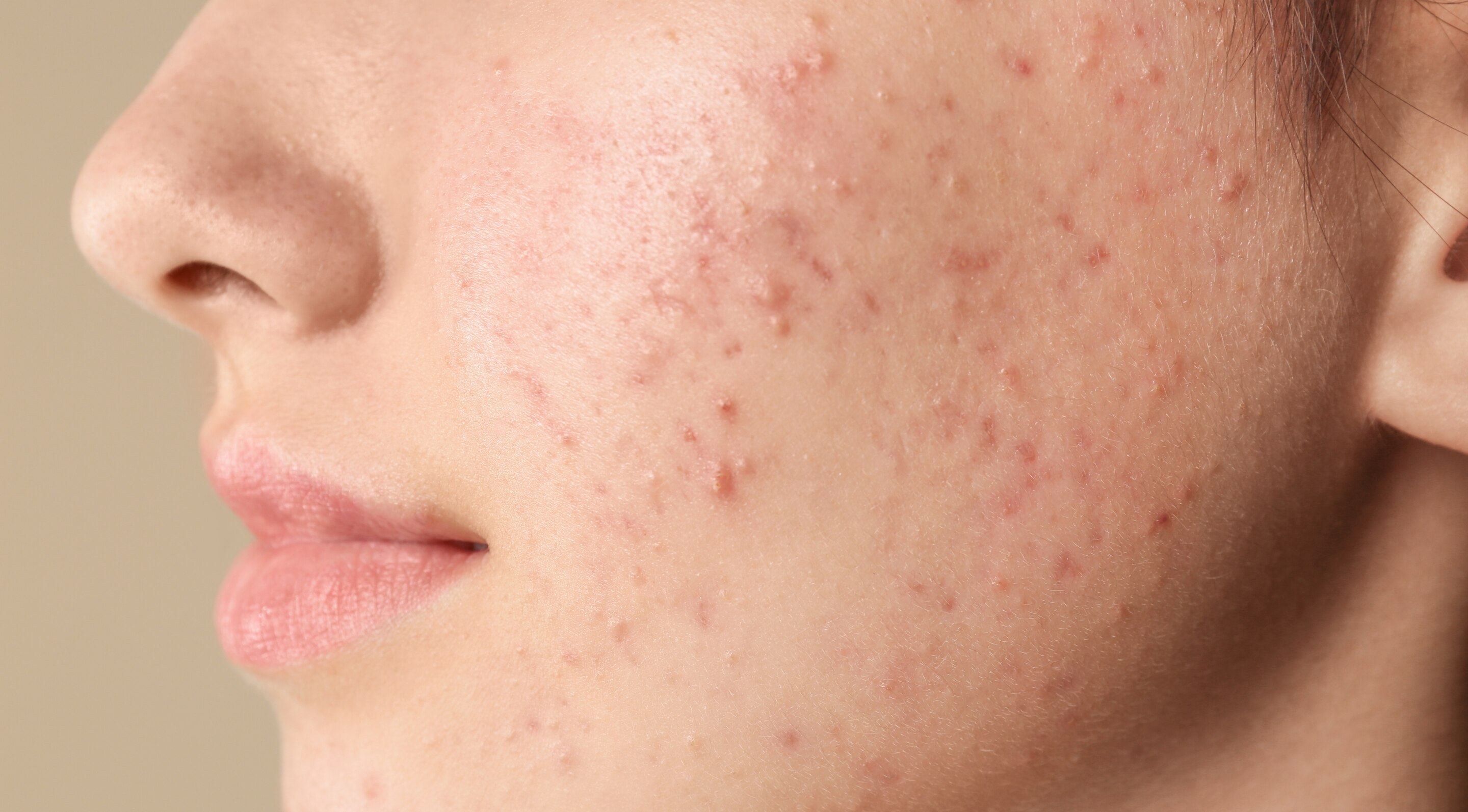 3.  Acne Treatment and Scar Fading