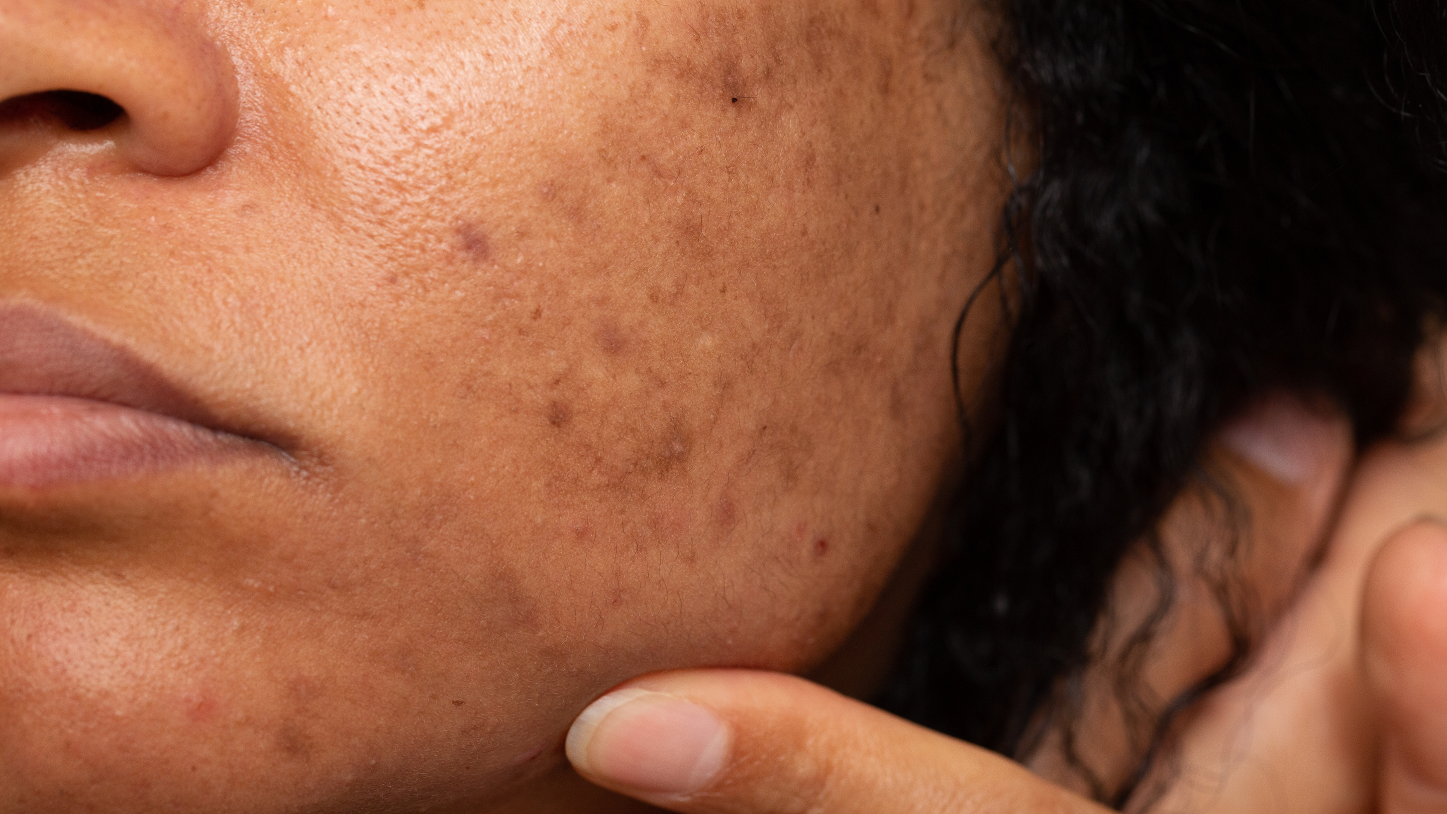 2. Reduces Hyperpigmentation