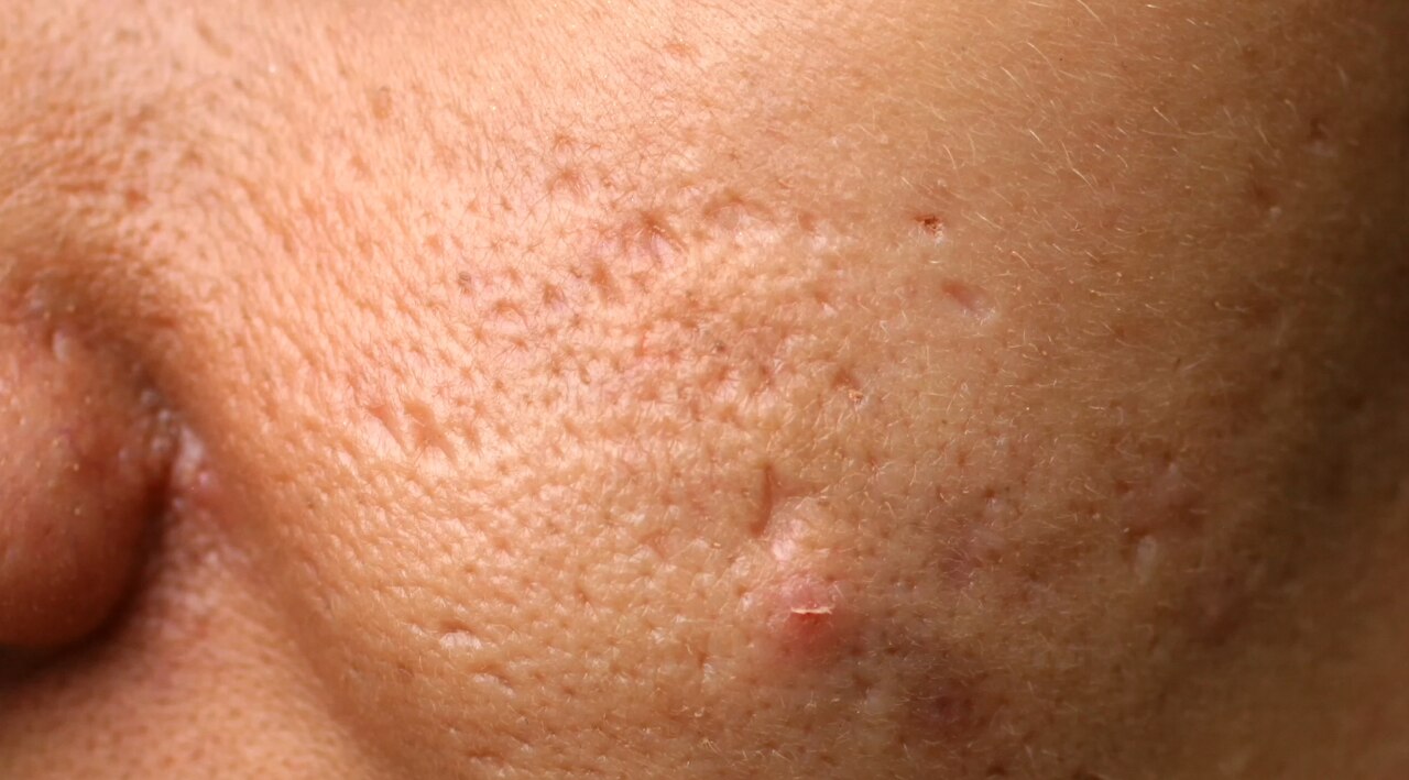 Skin Repair and Scar Healing: