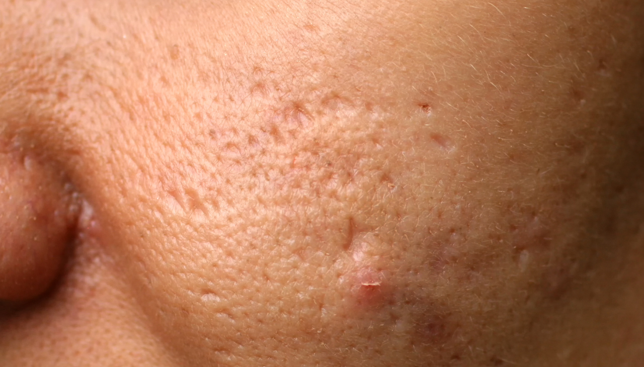 Skin Repair and Scar Healing:
