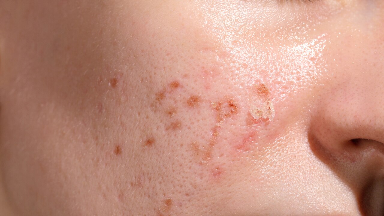Who Should Avoid Using Vitamin E on Face