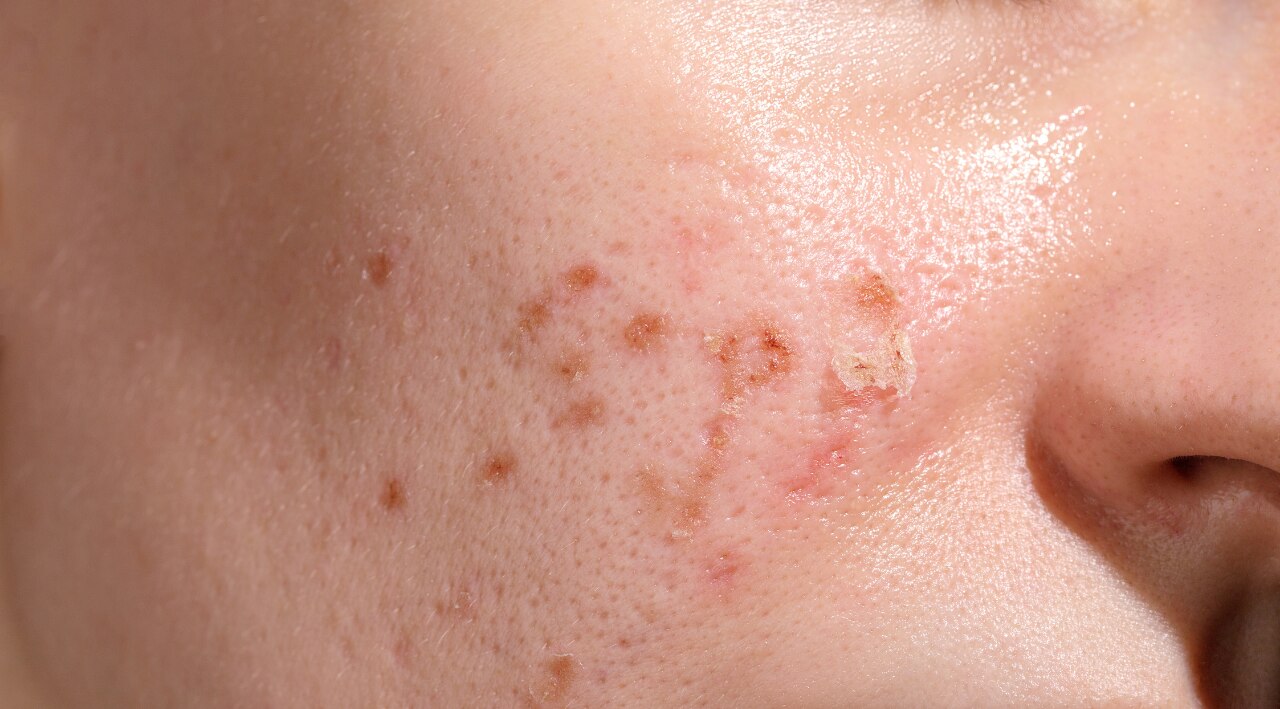 Who Should Avoid Using Vitamin E on Face