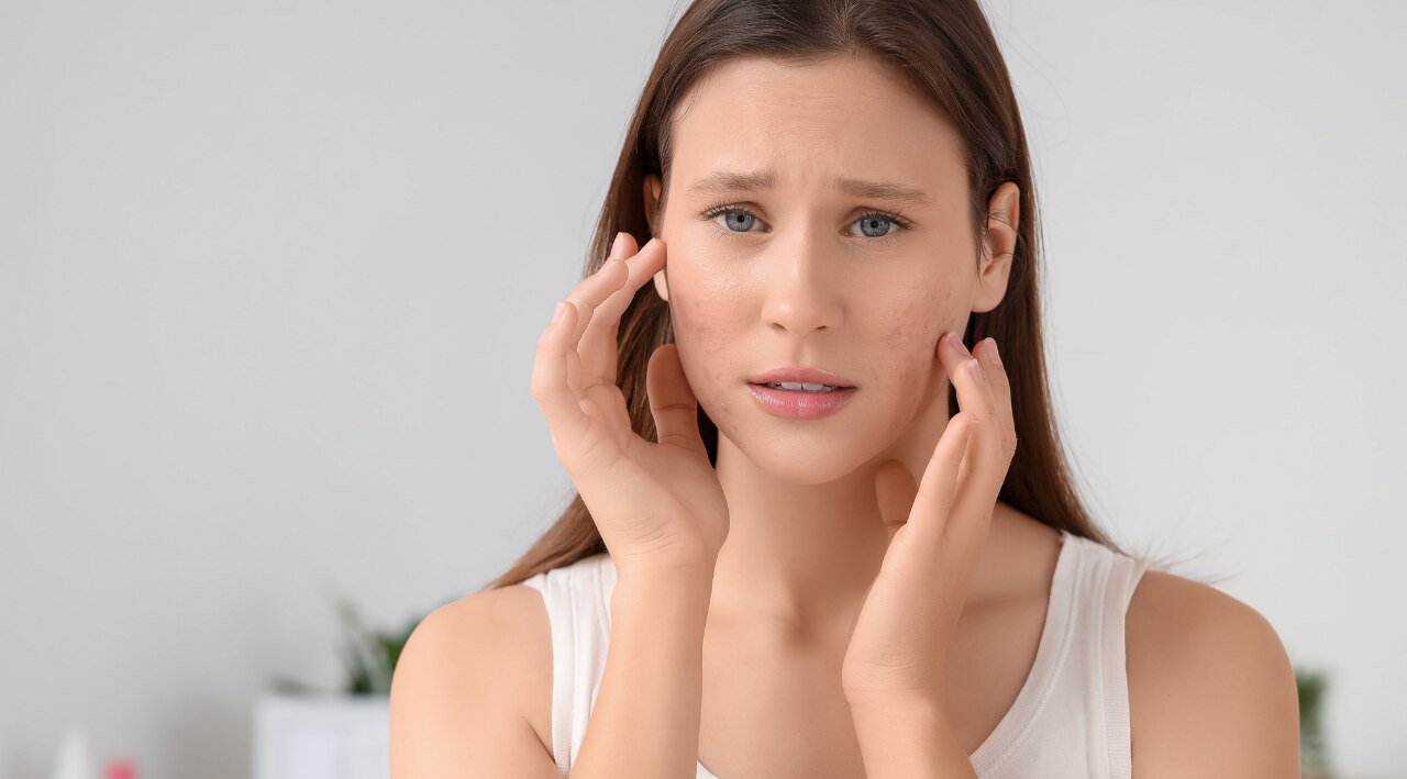 3. Acne Treatment and Prevention