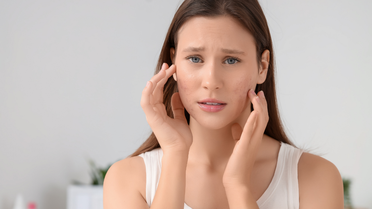 3. Acne Treatment and Prevention
