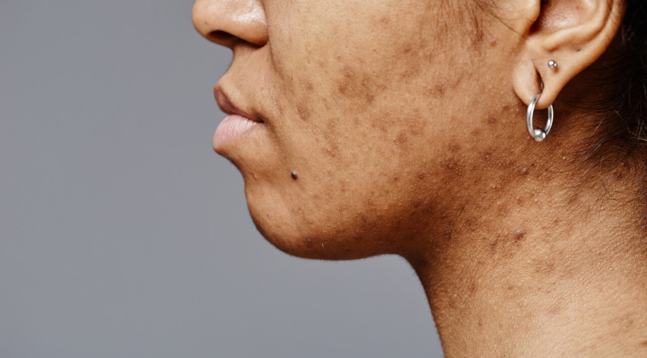 4. Dark Spot and Pigmentation Reduction