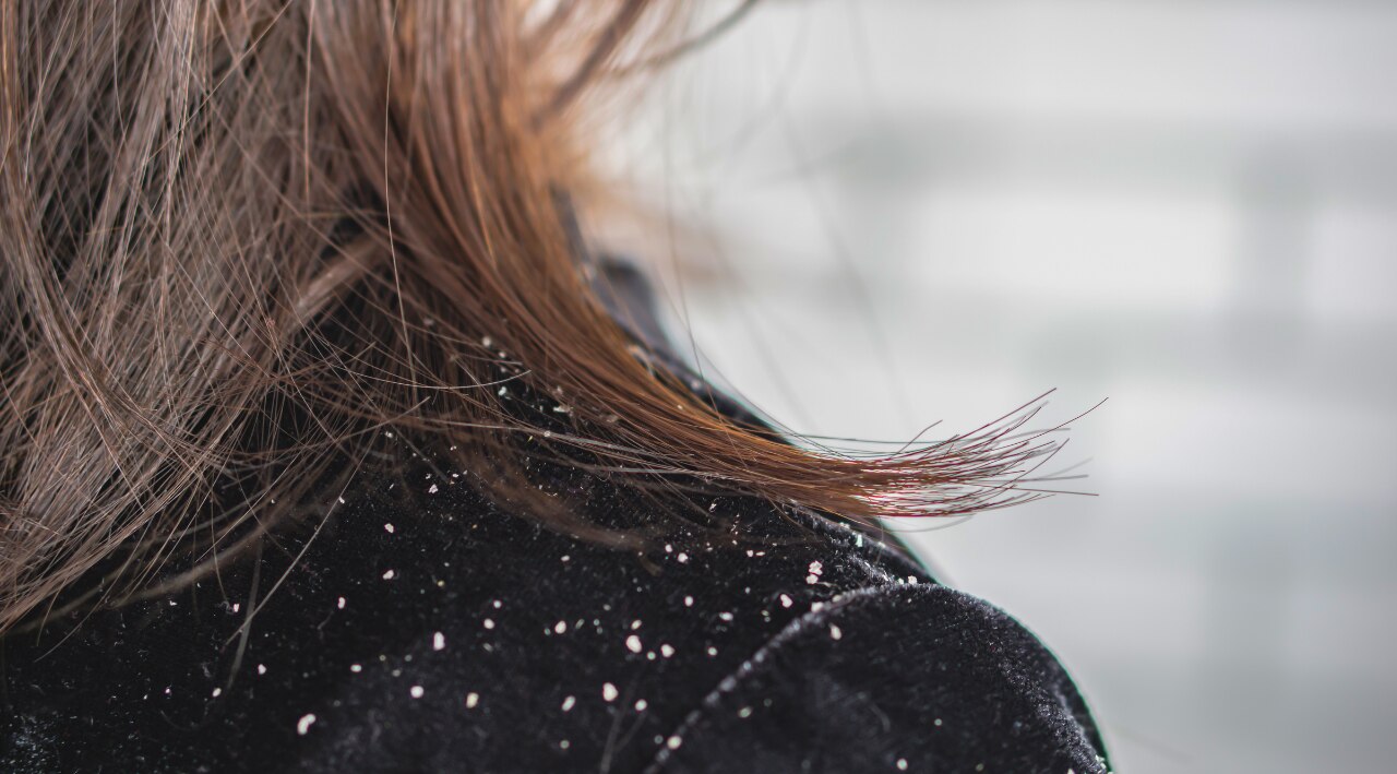 3. Prevents Dandruff