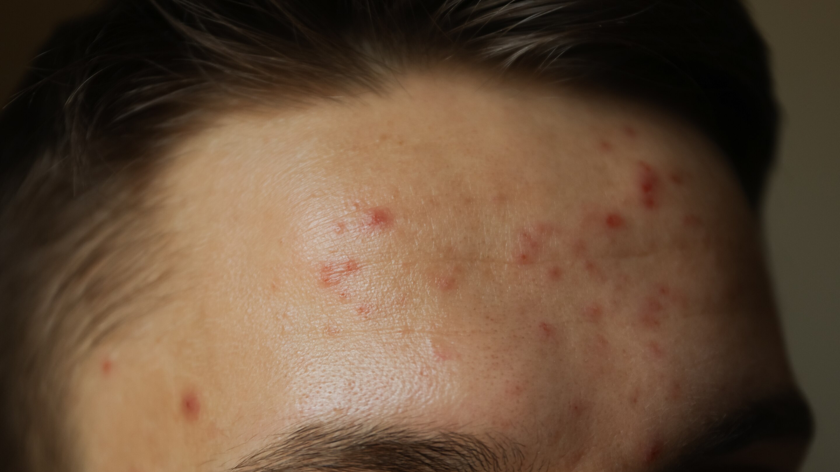 Fights acne: