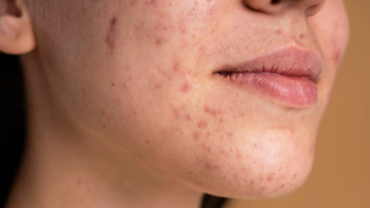 Acne-Prone & Oily Skin