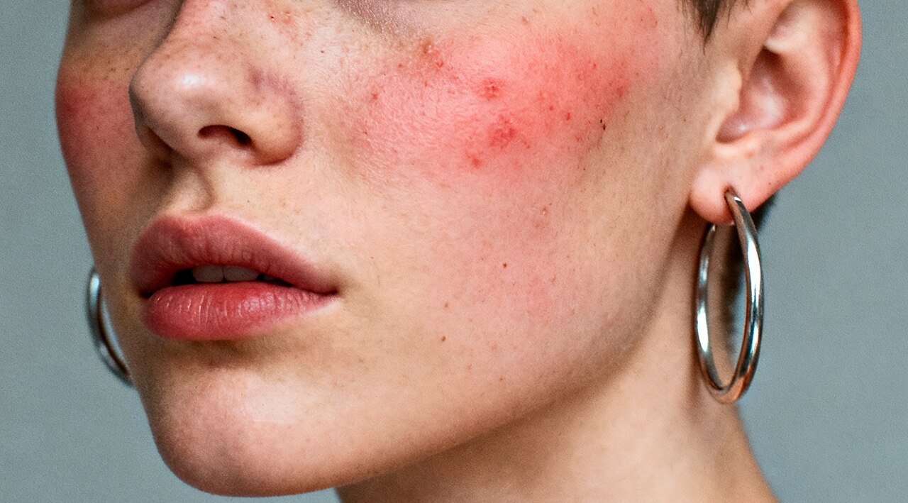 Possible Side Effects of Azelaic Acid