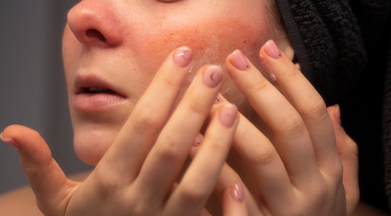 Sensitive & Rosacea-Prone Skin