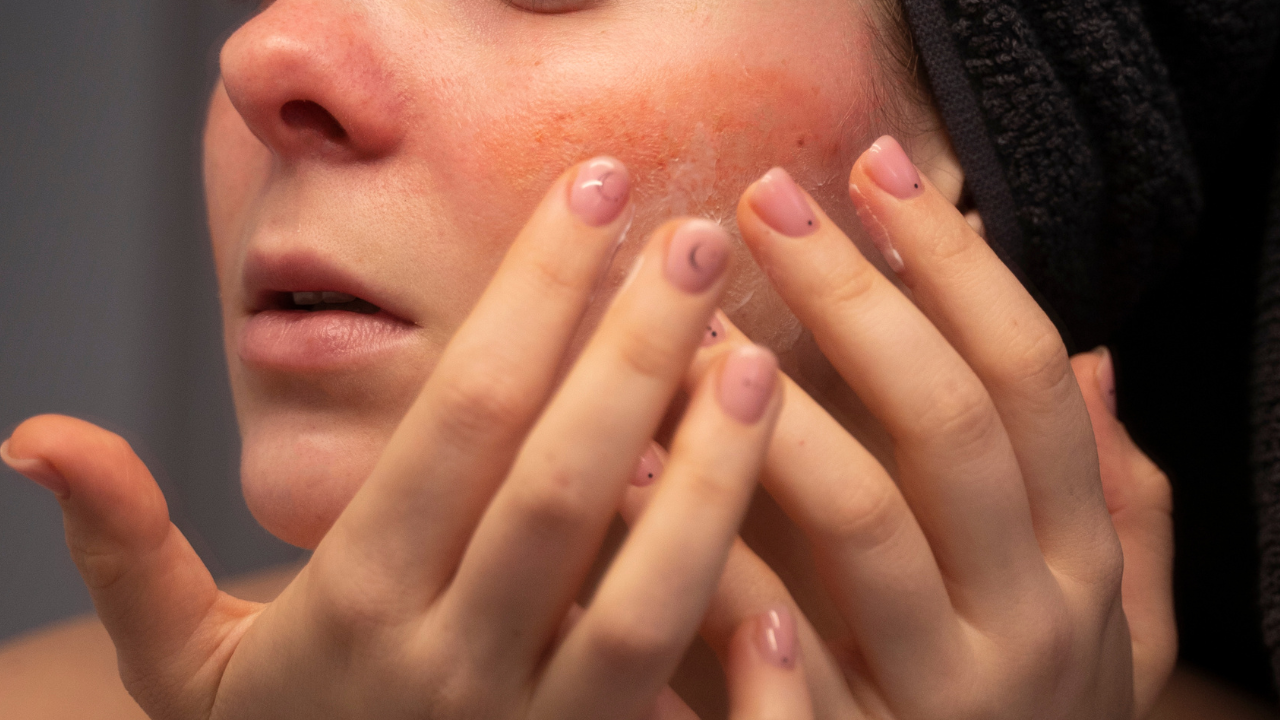 Sensitive & Rosacea-Prone Skin
