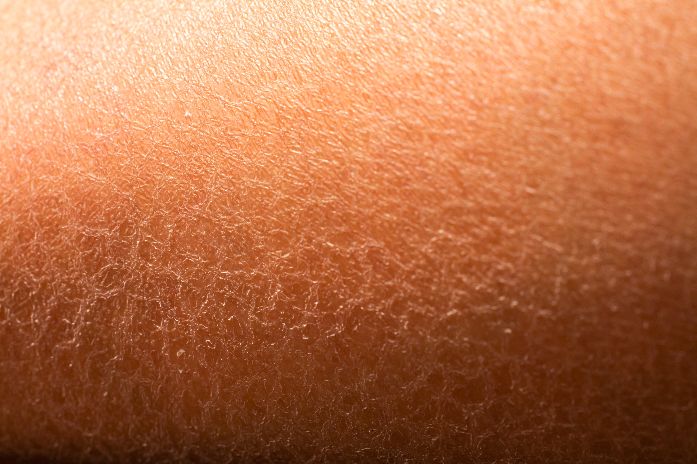 Seperti di foto, terlihat tekstur kulit kering yang mulai mengelupas.