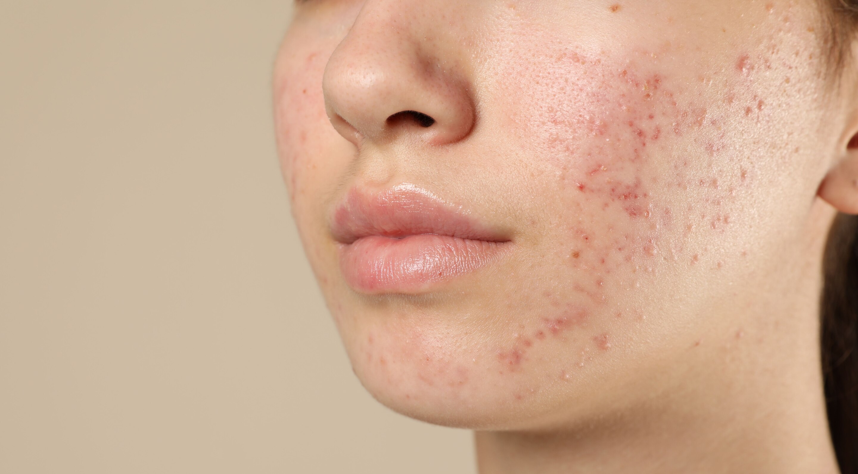 Acne Treatment: