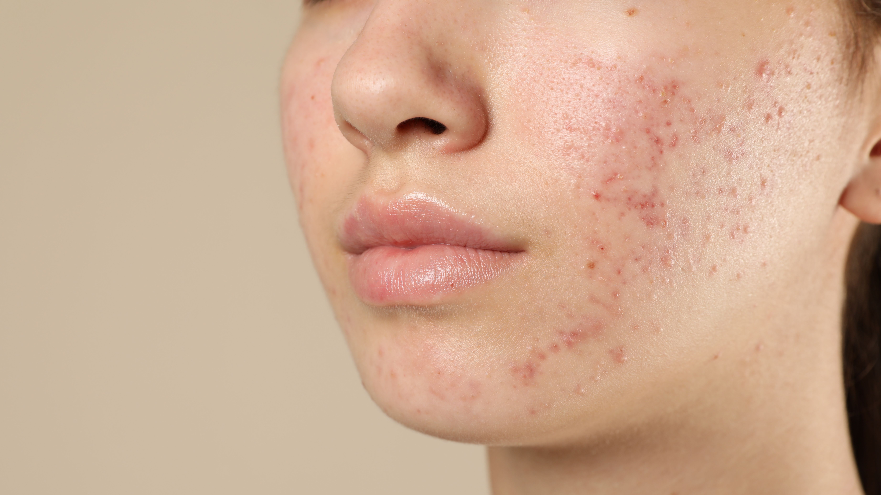Acne Treatment: