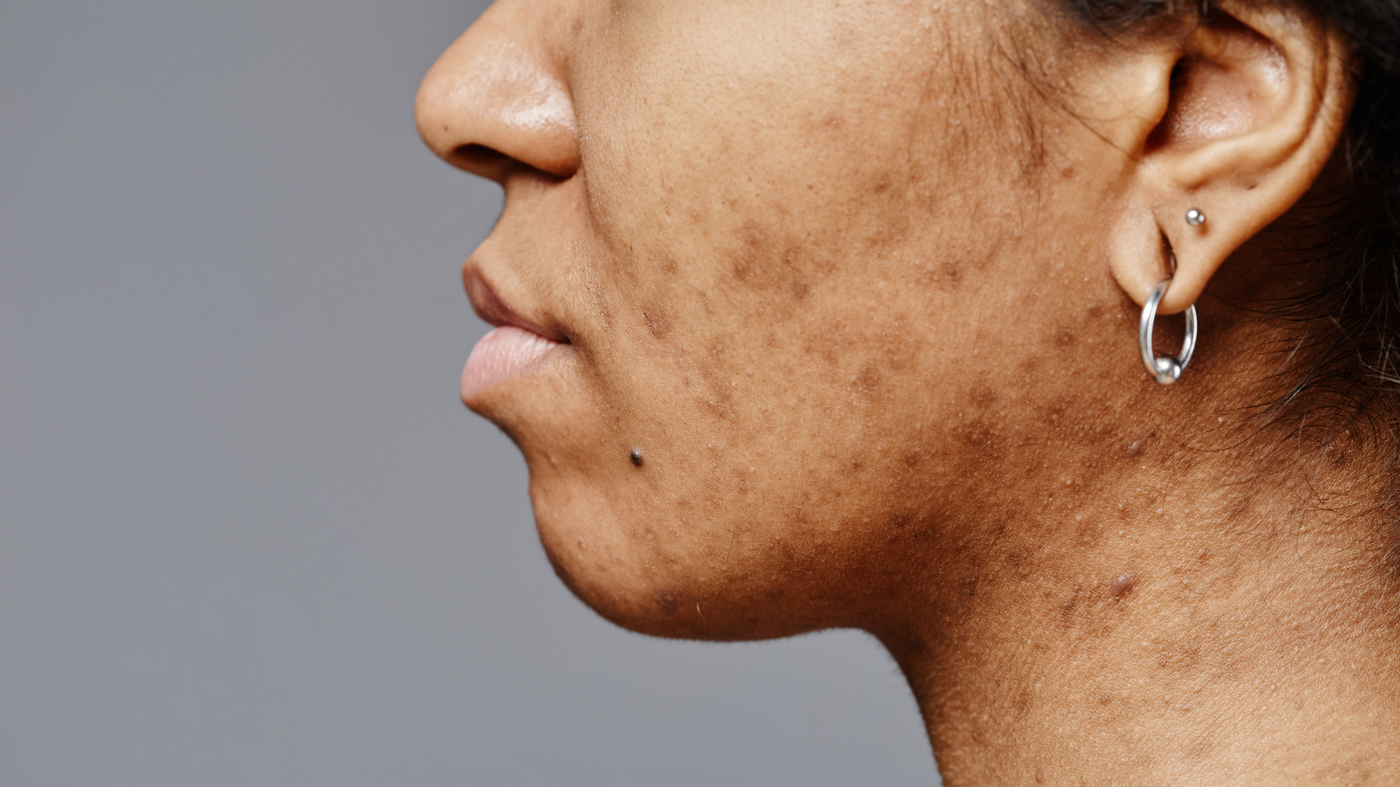 Fades Dark Spots and Hyperpigmentation: