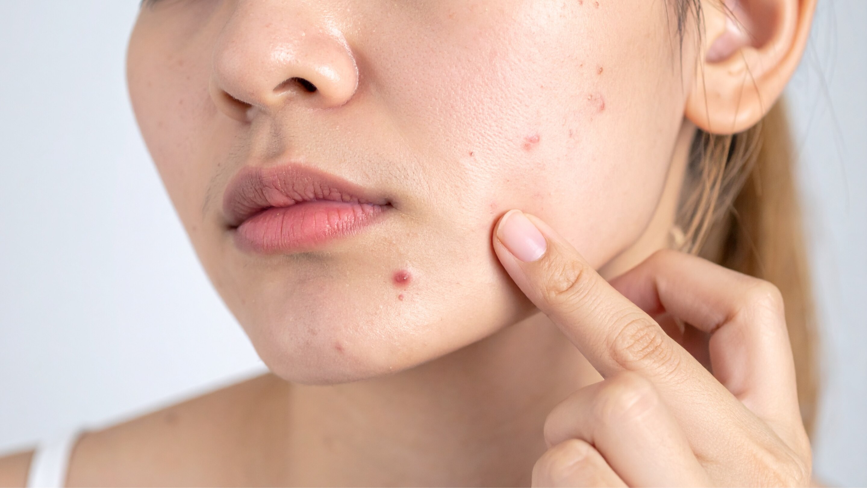 Reduces Acne & Soothes Skin: