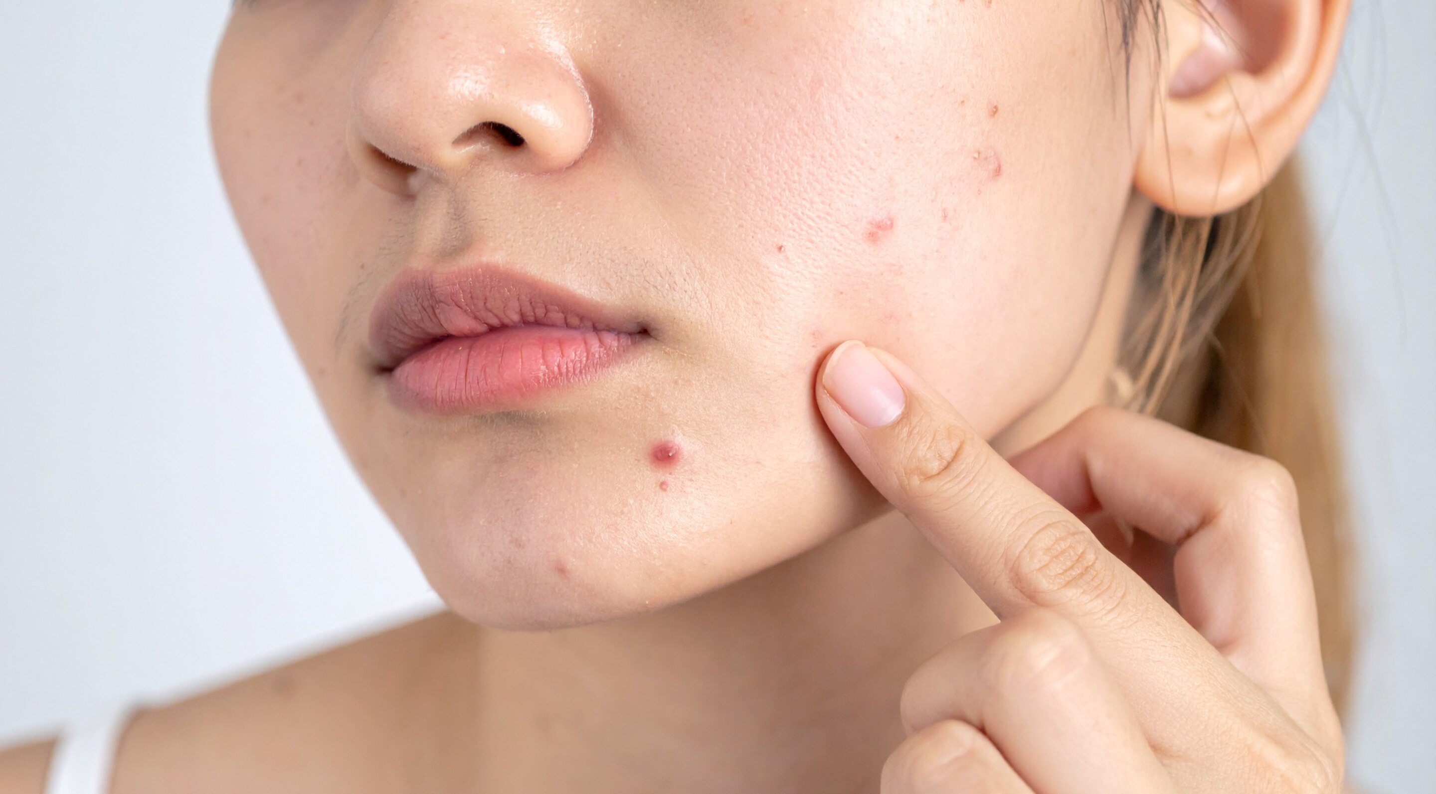Reduces Acne & Soothes Skin: