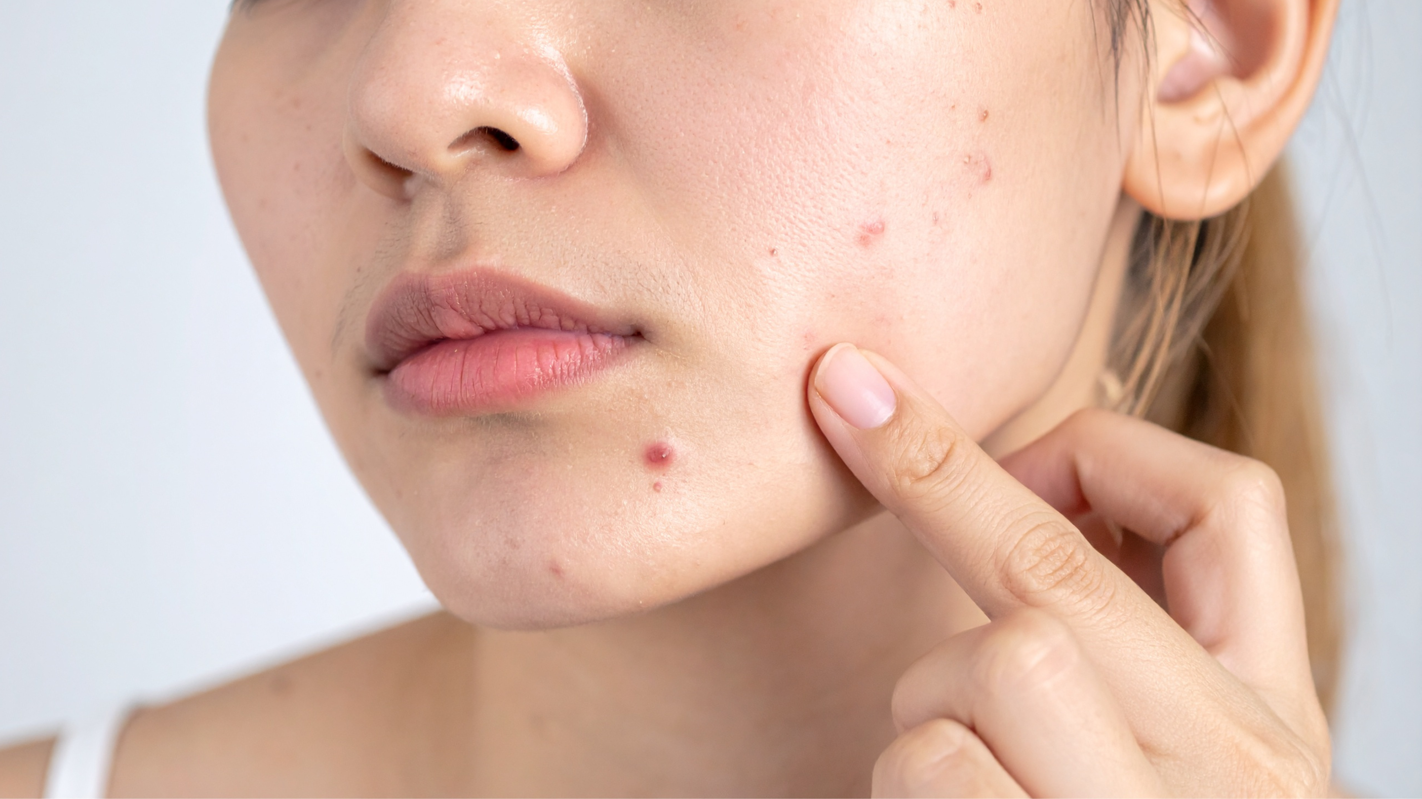 Reduces Acne & Soothes Skin: