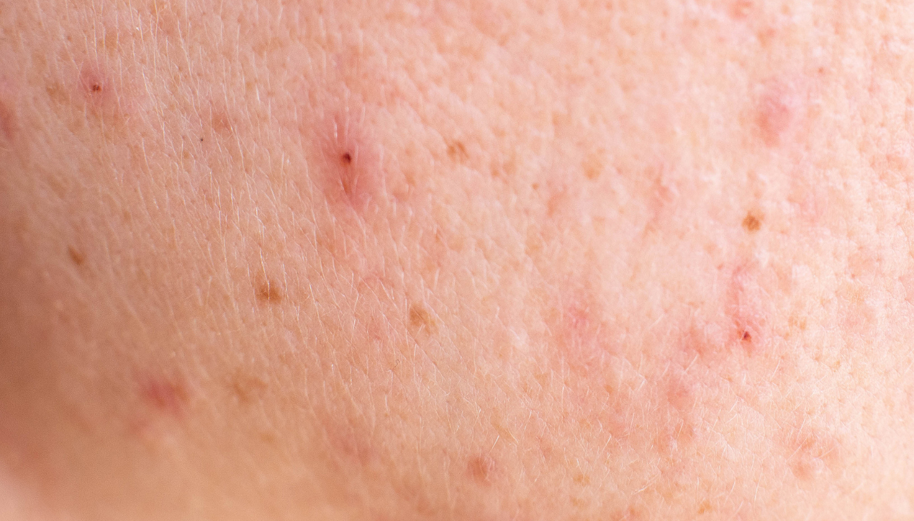 Fights Acne & Pimples: