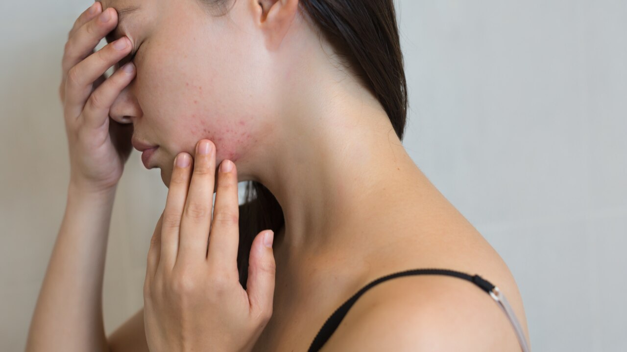 Possible Side Effects of Neem on Skin