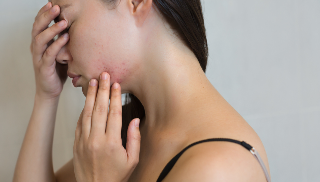 Possible Side Effects of Neem on Skin