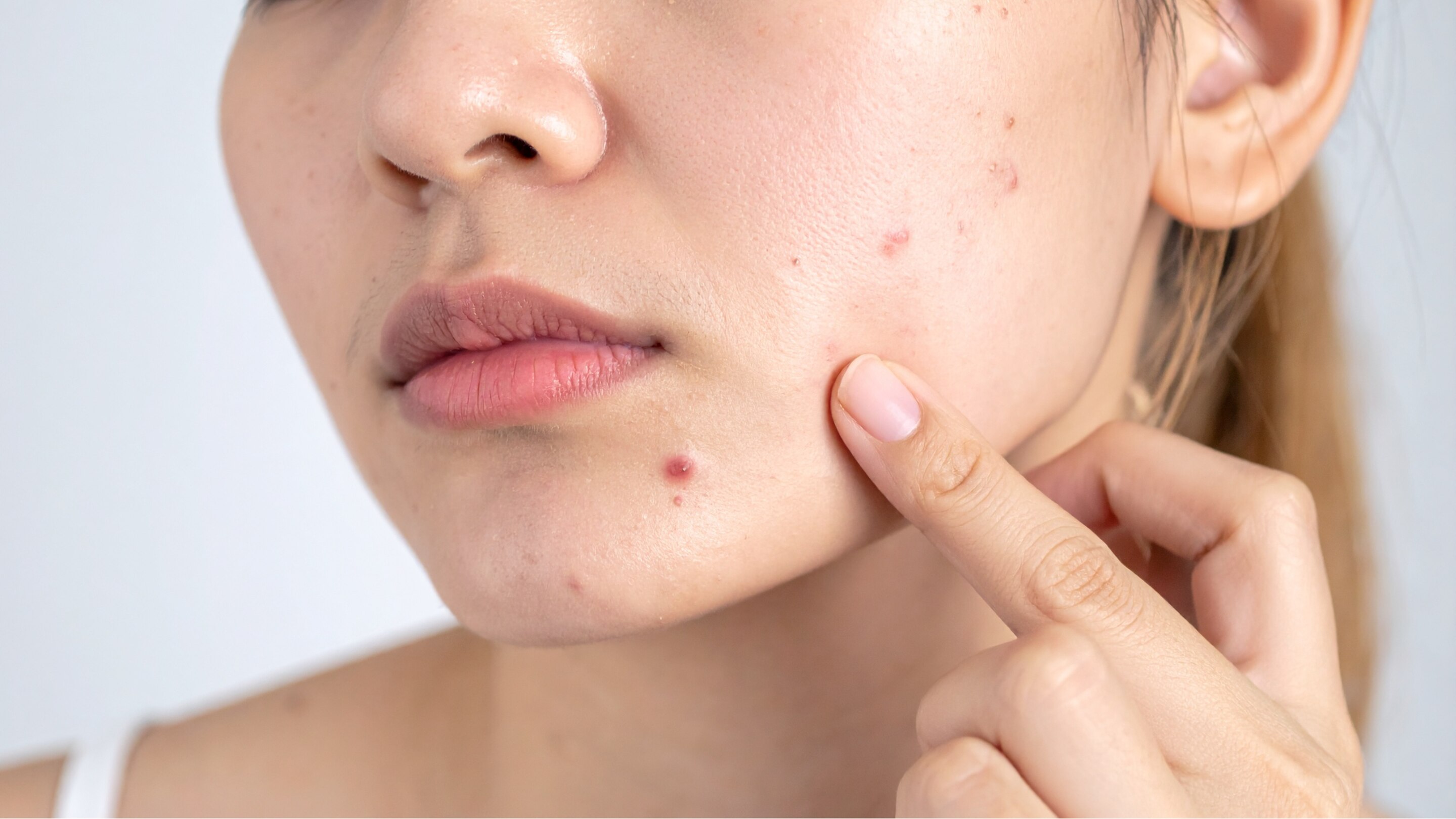 Acne & Blemish Reduction: