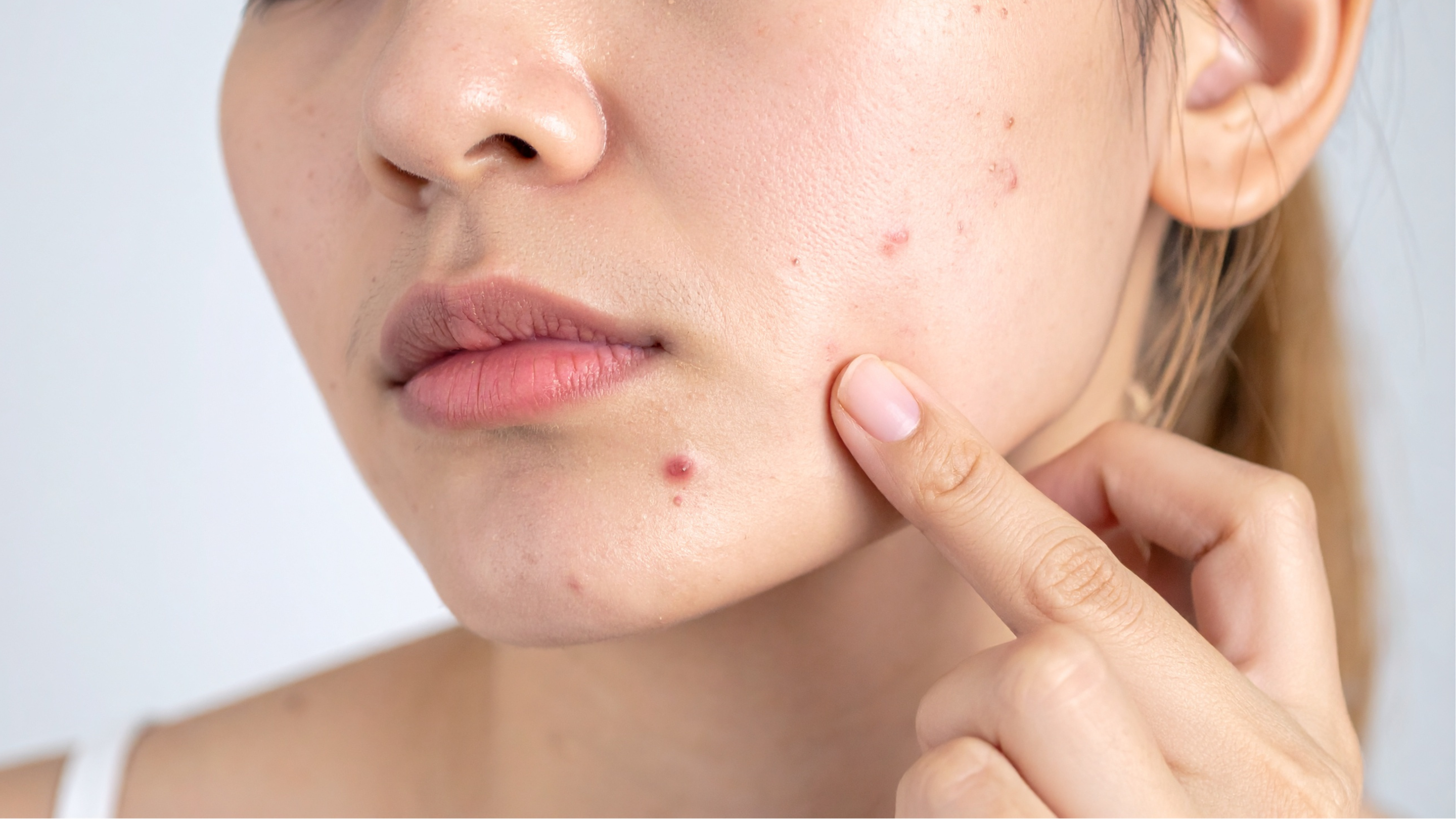 Acne & Blemish Reduction: