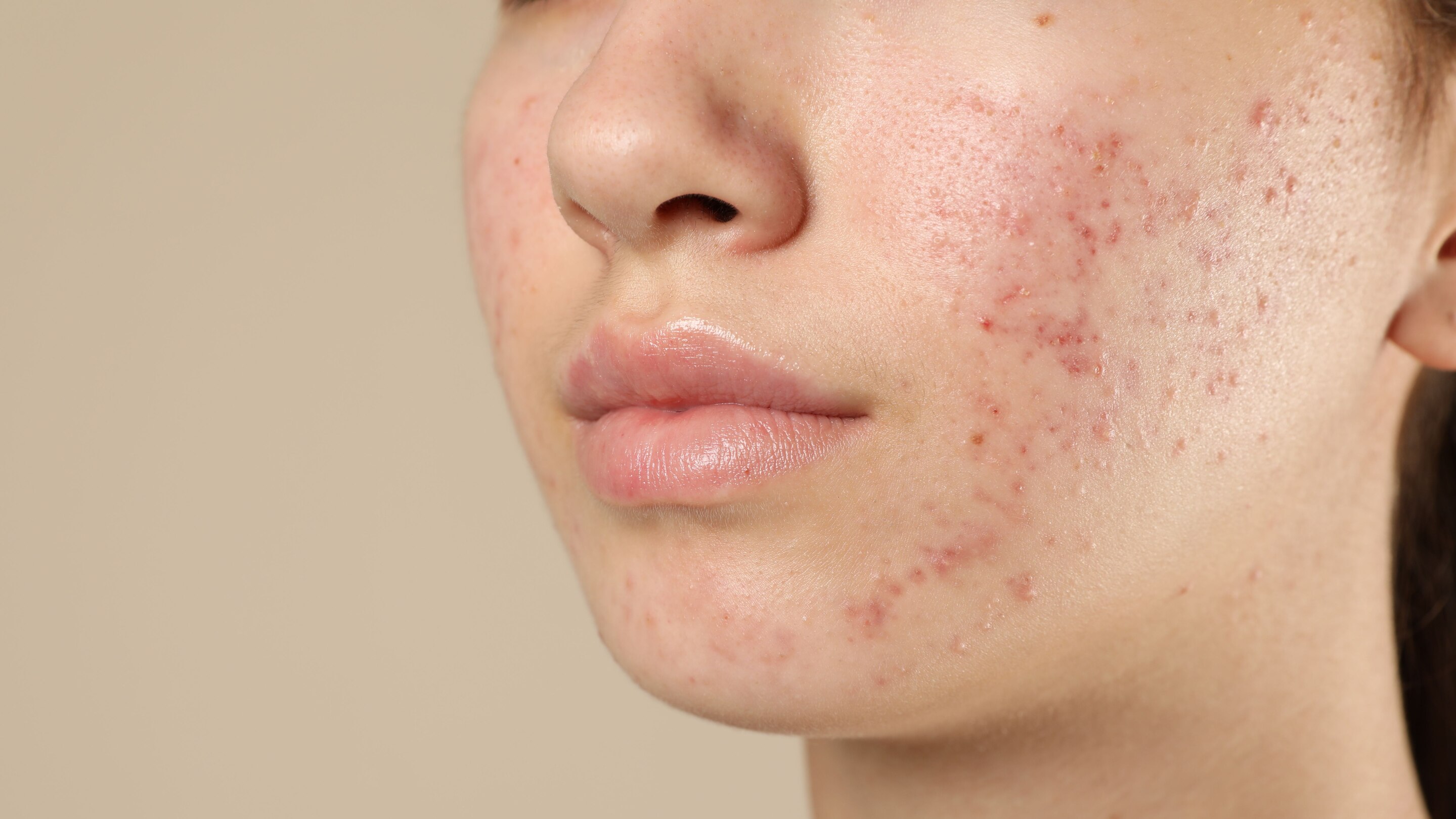 Exfoliation: