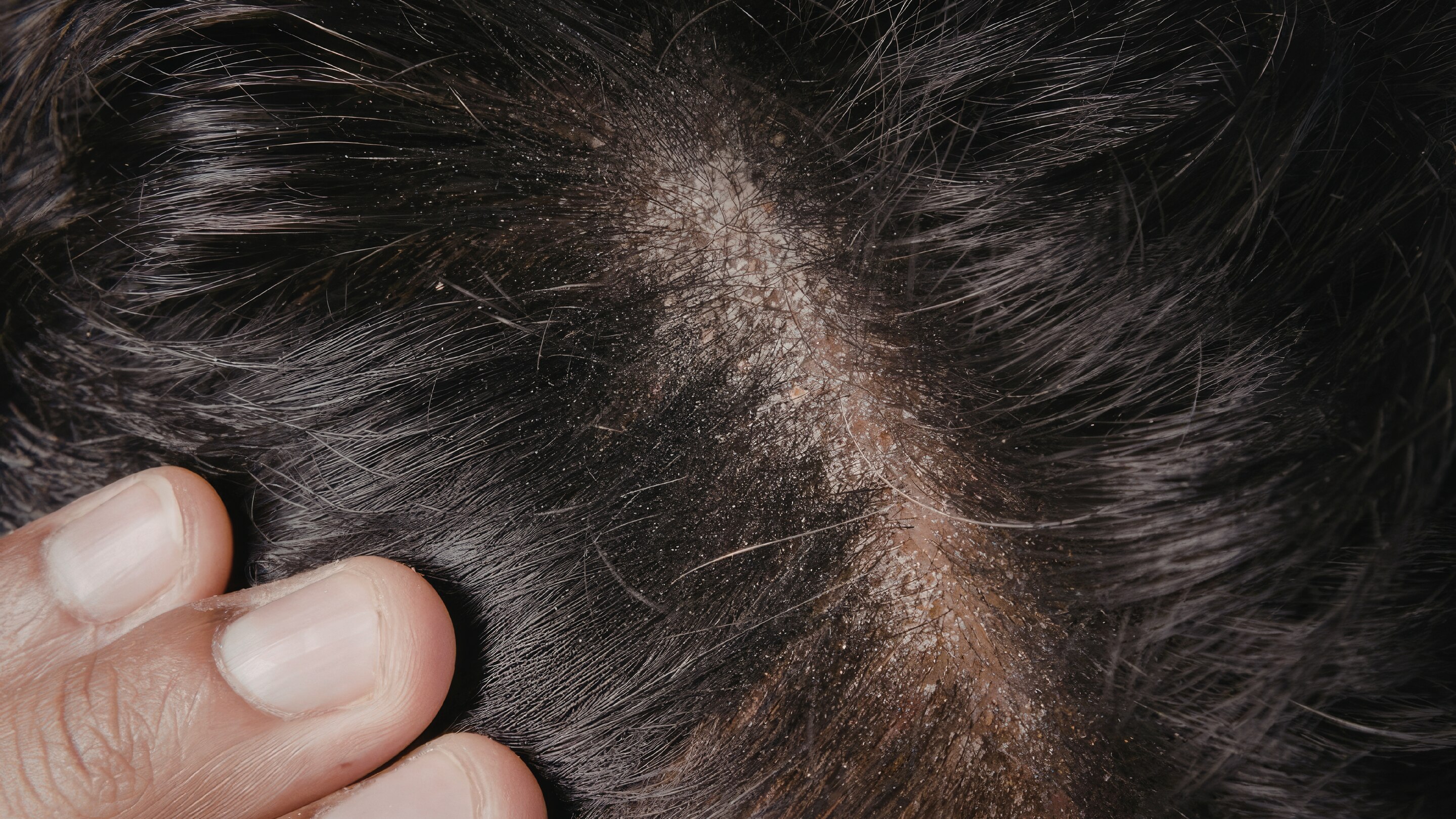 Helps Control Dandruff and Dryness Effectively