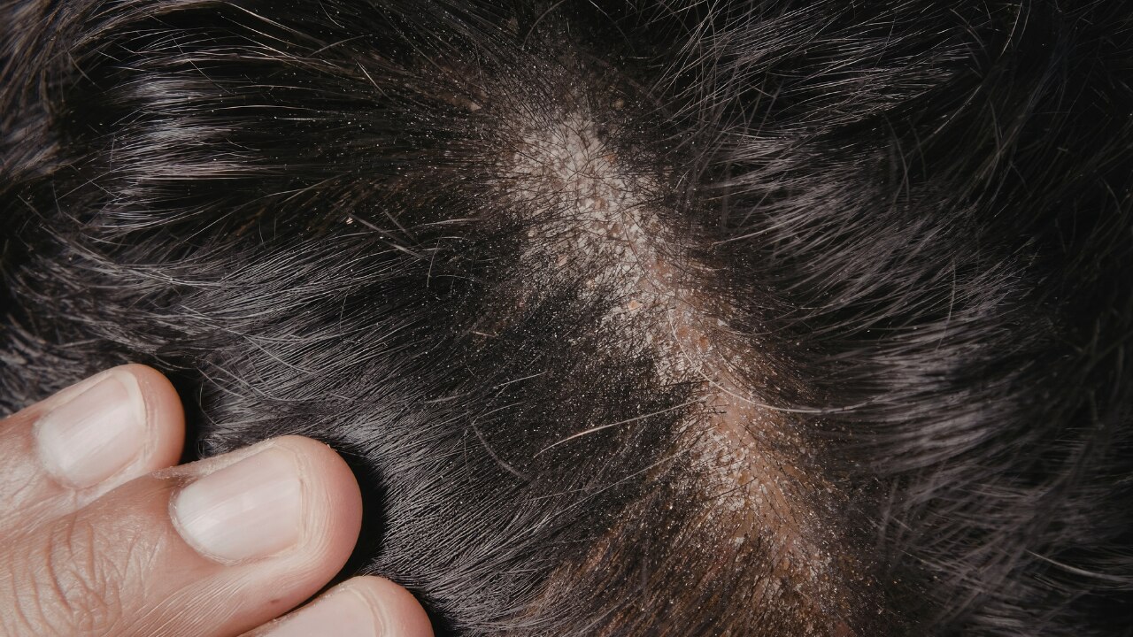 Keep your scalp clean