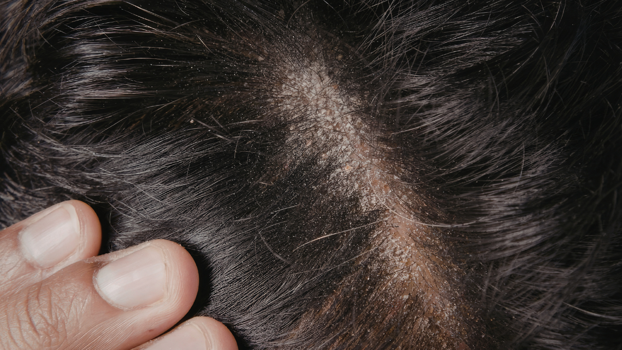 Keep your scalp clean