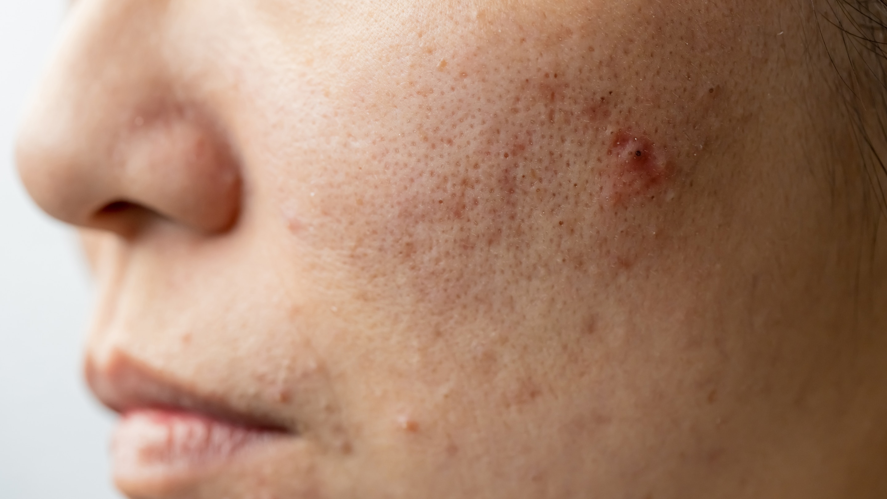 Benefits for Acne-Prone Skin