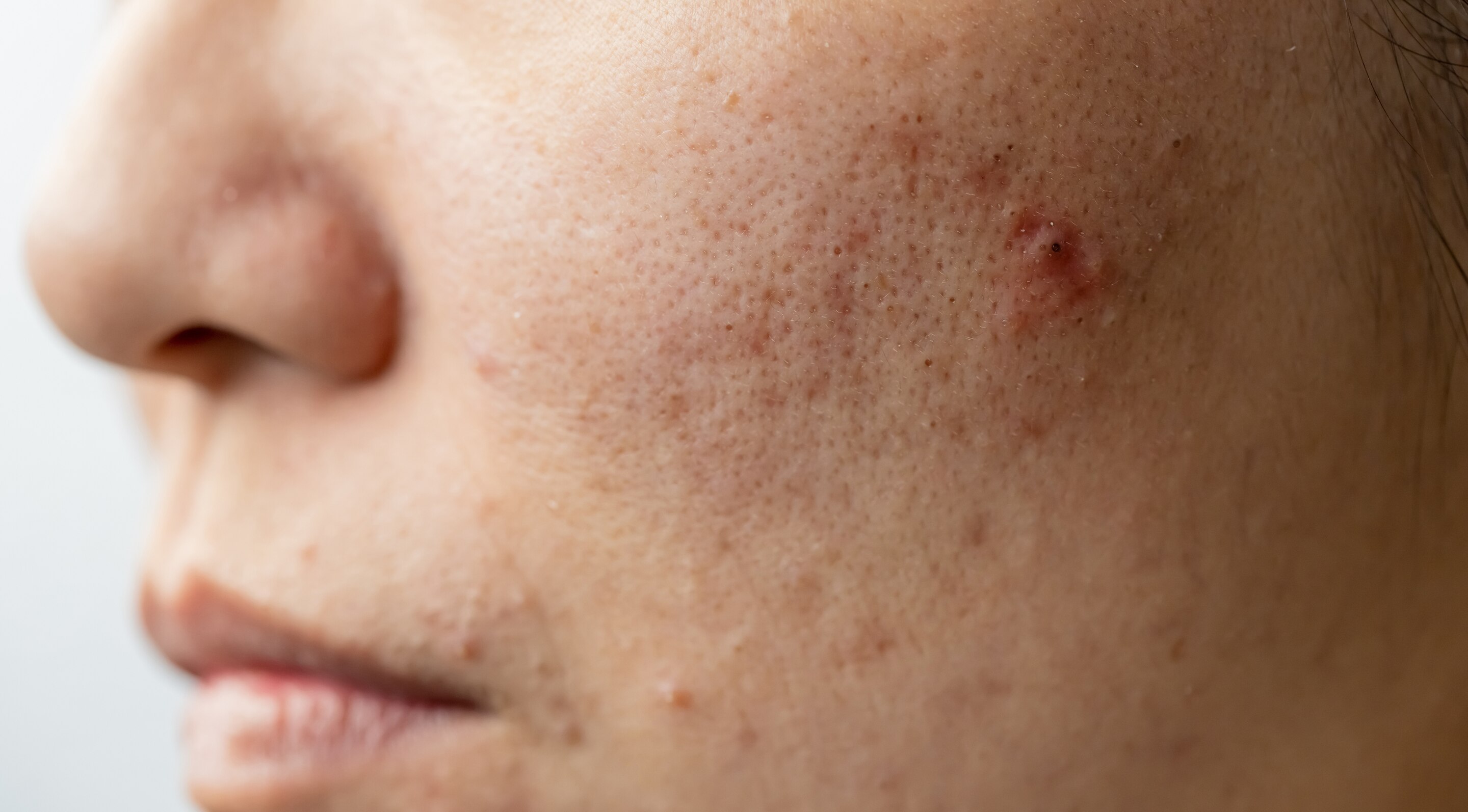 Benefits for Acne-Prone Skin