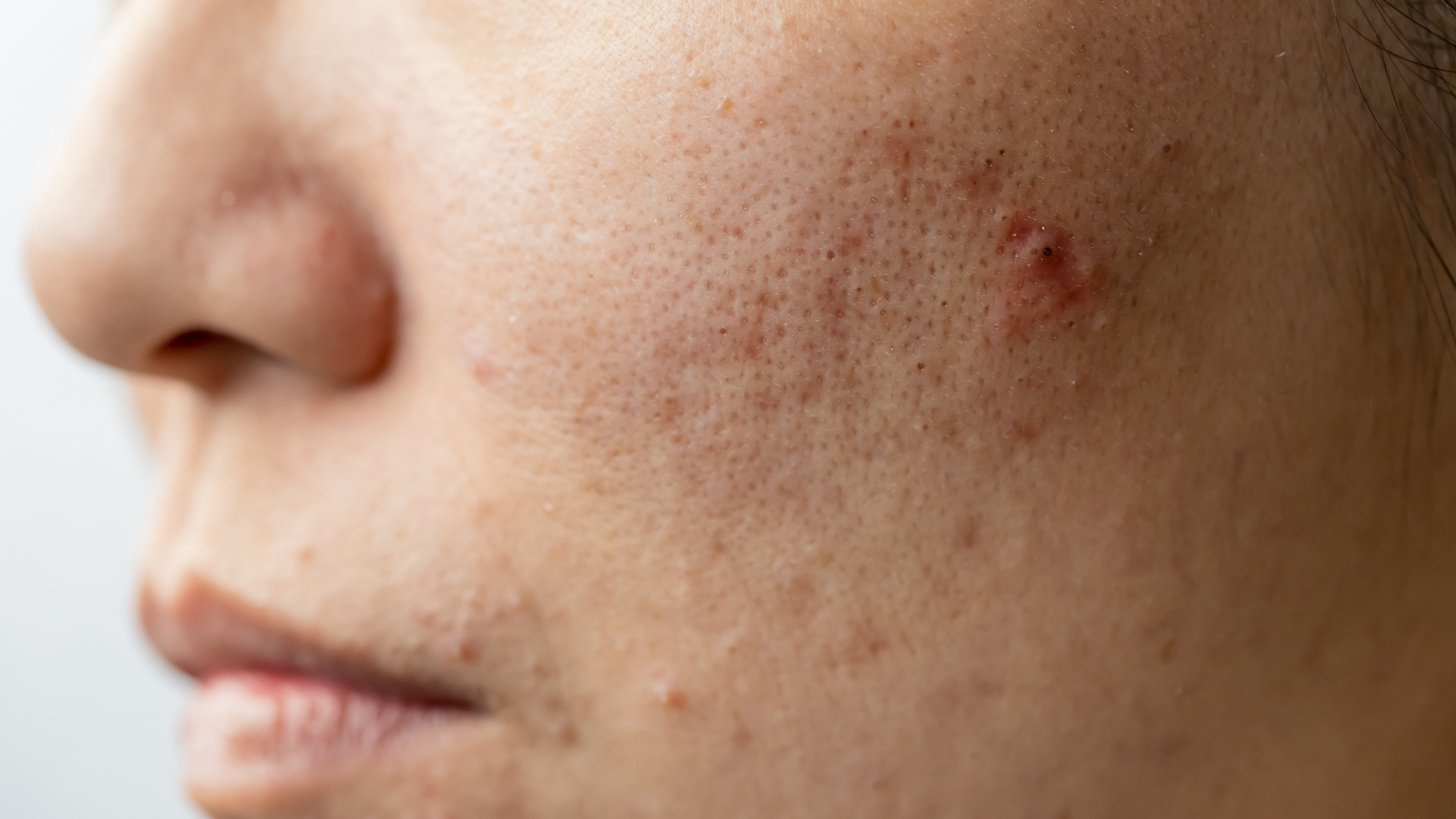 Benefits for Acne-Prone Skin