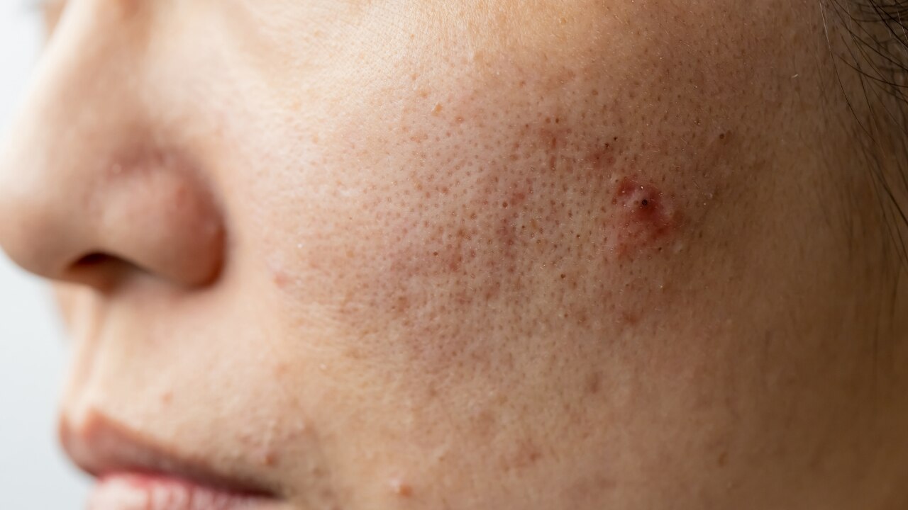 Acne Prevention and Healing: