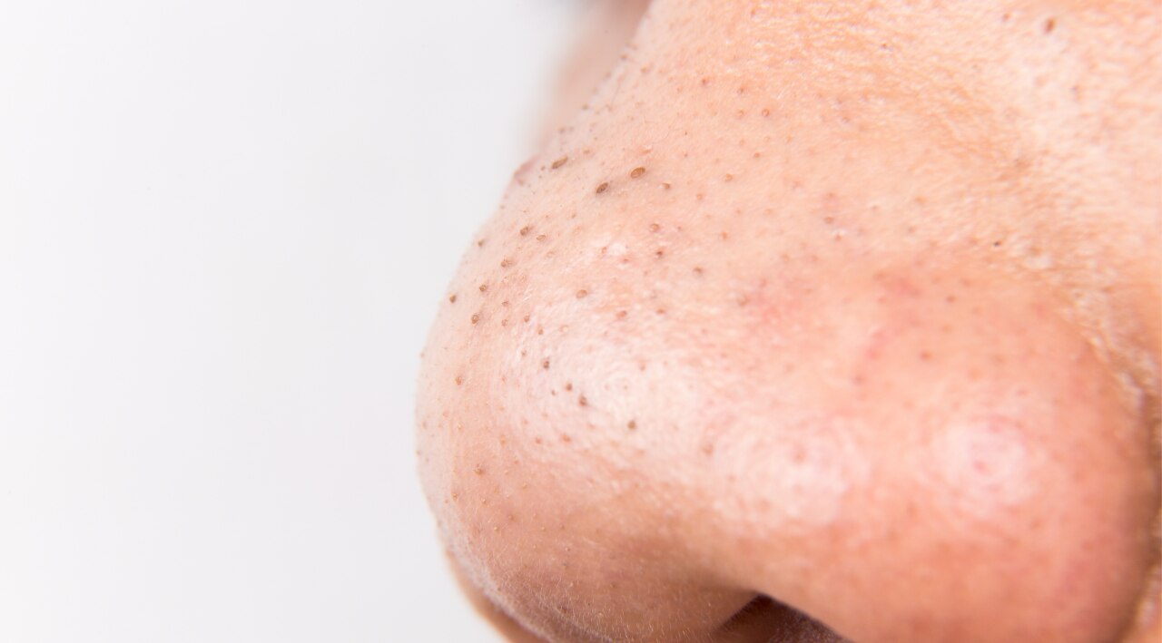 2. Blackheads & Whiteheads Removal