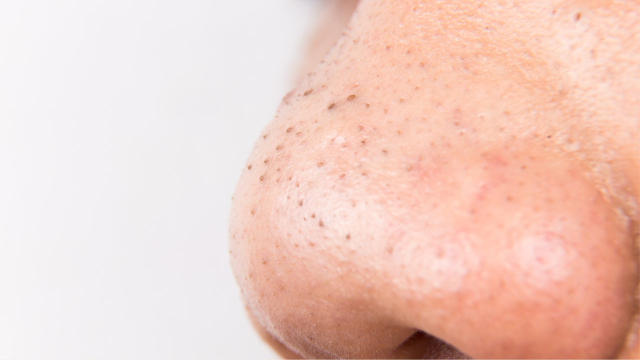 2. Blackheads & Whiteheads Removal