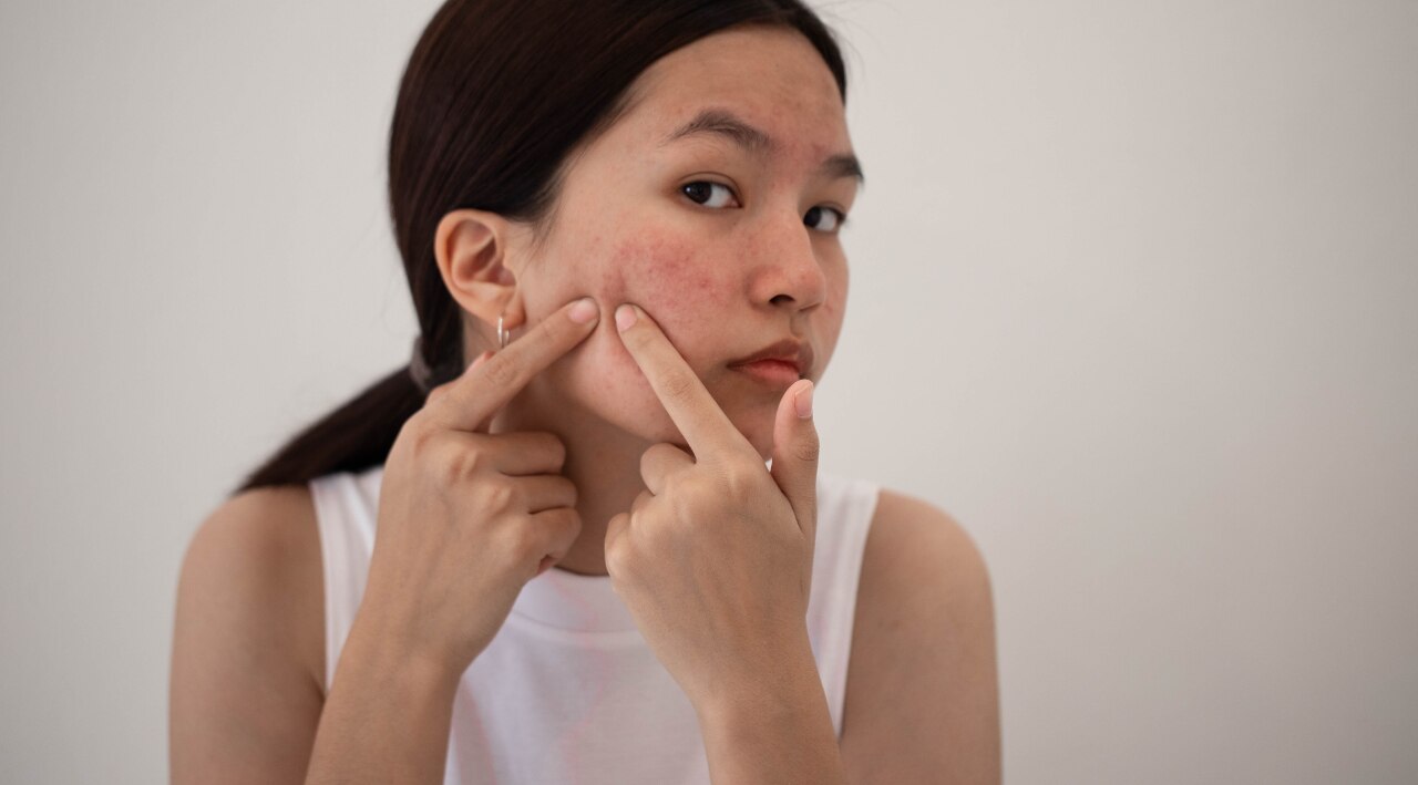 1. Acne Treatment