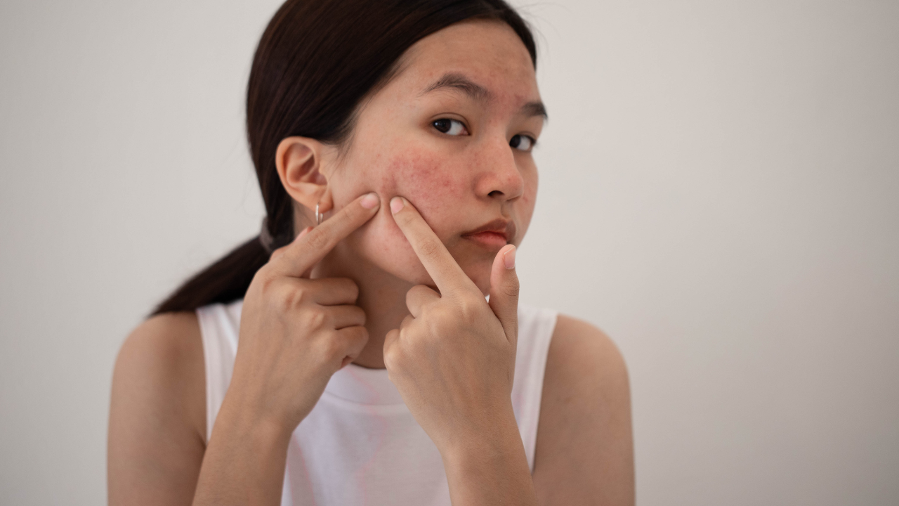 1. Acne Treatment