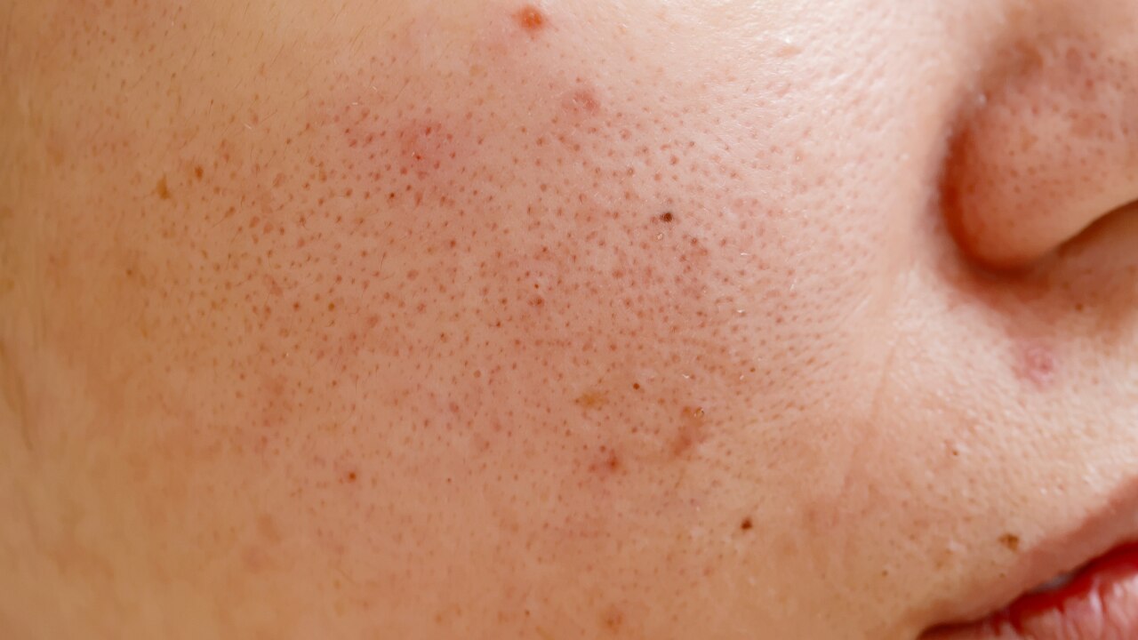 4. Spot Treatment